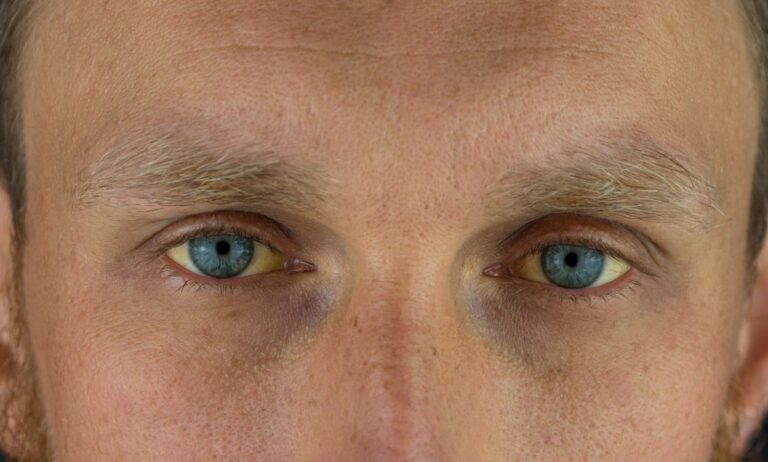 #Salud: 11 señales de intoxicación hepática que debes tener en cuenta