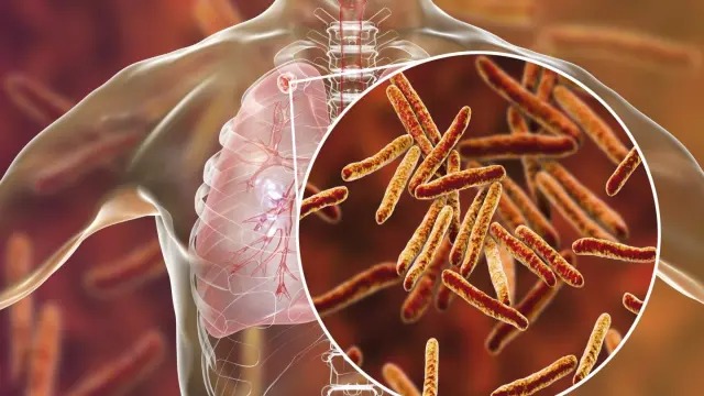 Se han diagnosticado 763 personas con tuberculosis en lo que va de año en RD