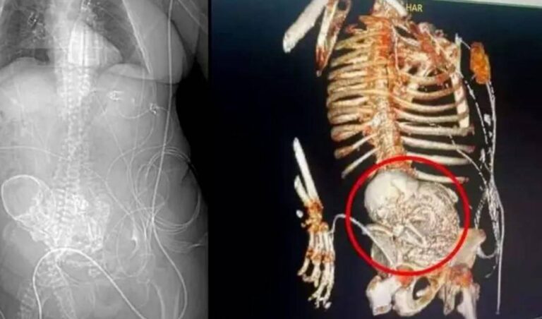 Mujer llevó en su vientre un feto calcificado por 40 años