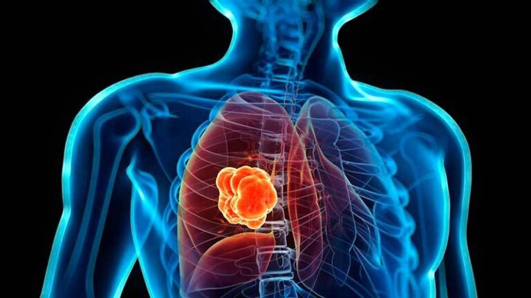 La polución es el nuevo factor de riesgo que dispara los casos de cáncer de pulmón en el mundo