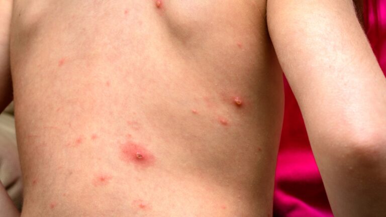 Sarampión en Estados Unidos: qué debes saber #FVDigital