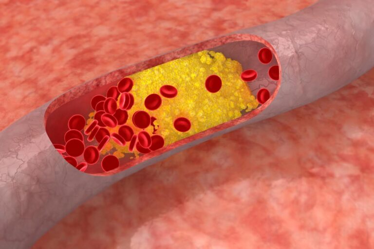 4 alternativas naturales para cuidar tus arterias