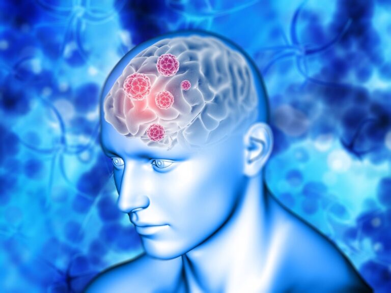 #Salud: 5 señales poco comunes de un tumor cerebral que no debes ignorar