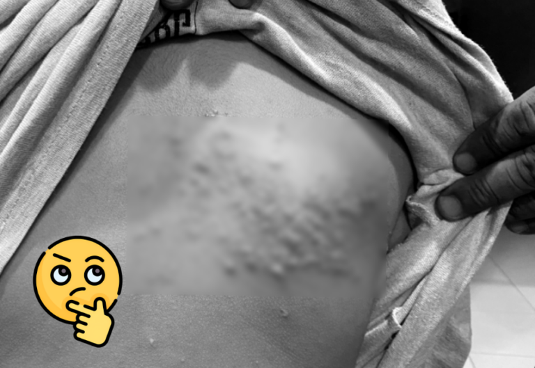 Cómo prevenir enfermedades virales como la culebrilla – Remolacha   #FVDigital