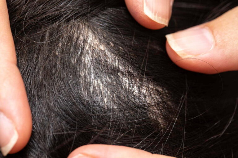 #Salud: Remedios caseros para eliminar piojos y liendres