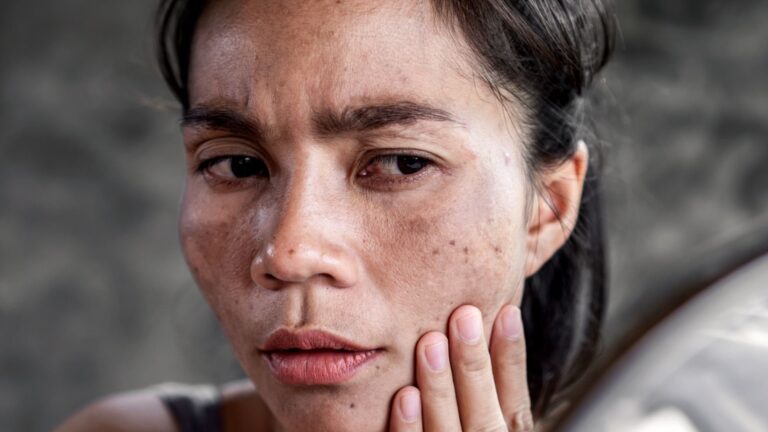 Nuevas recomendaciones para prevenir el cáncer de piel – #FVDigital