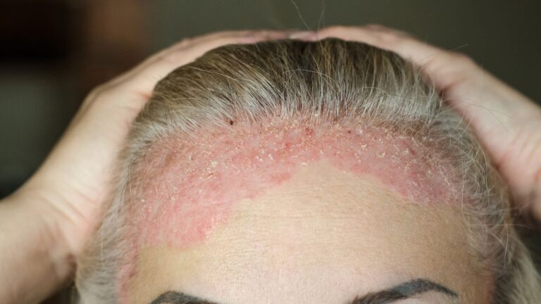 Día Mundial de la Psoriasis, una enfermedad que impacta en la vida del 60% de pacientes – #FVDigital