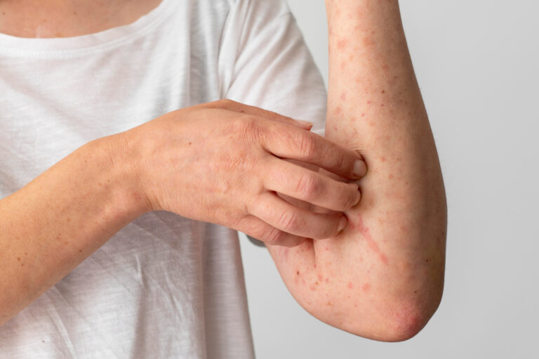 Urticaria. ¿Qué puede provocar esta reacción alérgica?