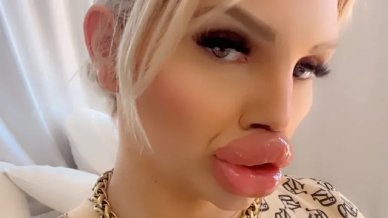 La influencer apenas puede comer por sus labios gigantes