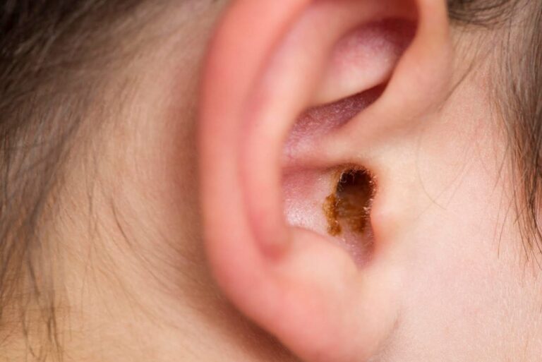 #Salud: ¿Cómo eliminar el cerumen de los oídos sin dañarlos?