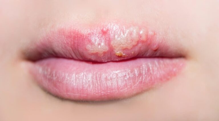 #Salud: ¿De dónde viene el herpes labial?