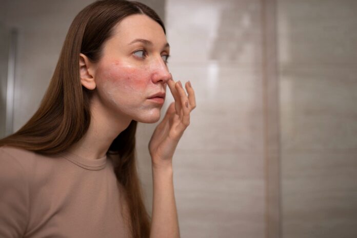 Como-tratar-la-rosacea-consejos-para-el-cuidado-de-la-piel.jpg