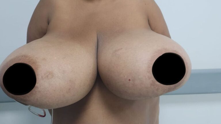 Retiran más de 30 libras de senos a una mujer en un operativo quirúrgico en Barahona