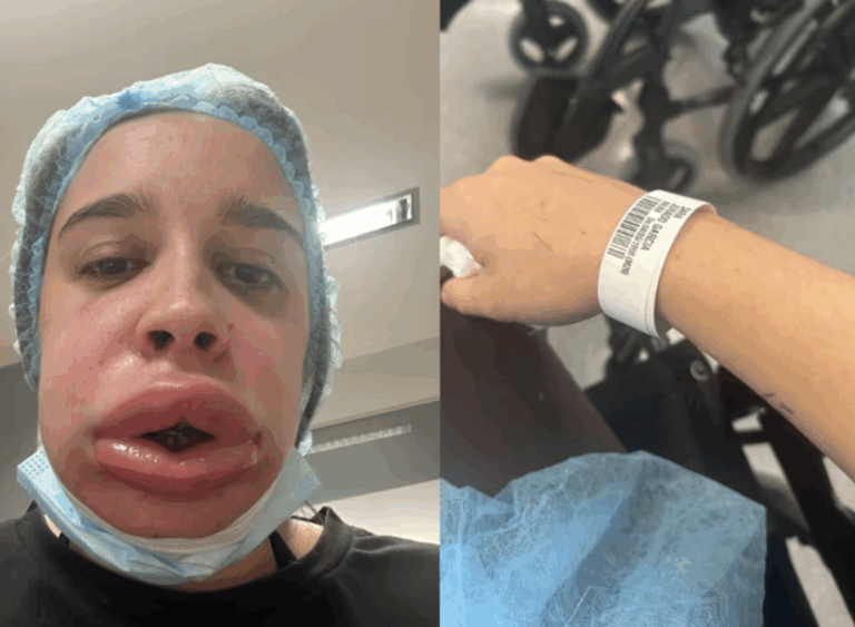 #Salud: Entró a una estética para retirarse el ácido hialurónico… y salió irreconocible