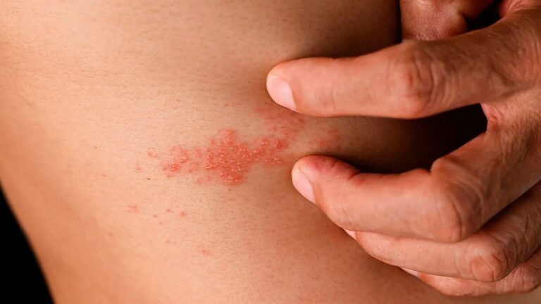 Vacuna contra el herpes zóster podría reducir el riesgo de demencia en mayores