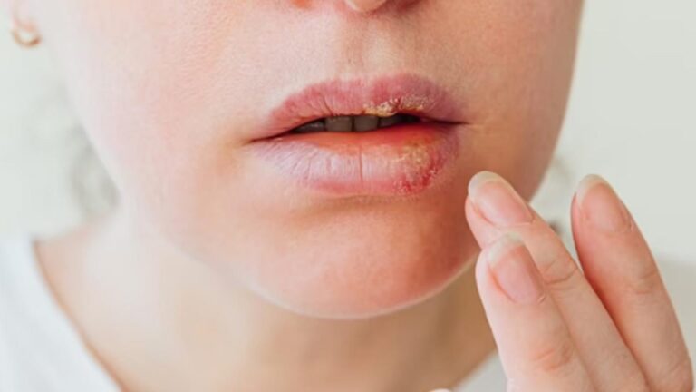 Descubren vínculo entre el herpes labial y el riesgo de sufrir Alzheimer