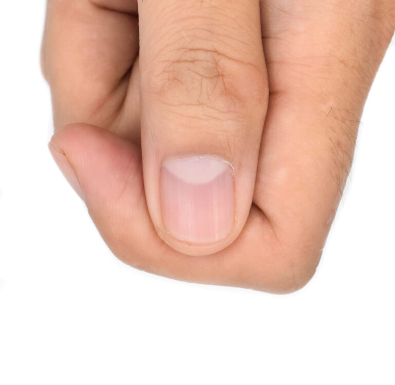 #Salud: ¿Tienes esta marca bajo la uña? Podría ser una señal temprana de cáncer
