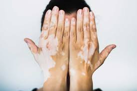 Vitiligo.jpg