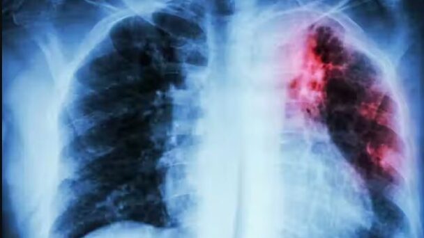TUBERCULOSIS-608x342.jpg