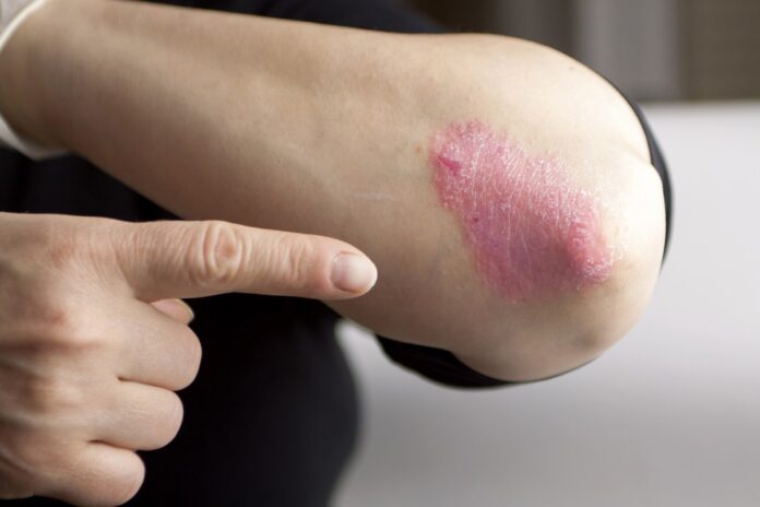 psoriasis-shutterstock.jpg
