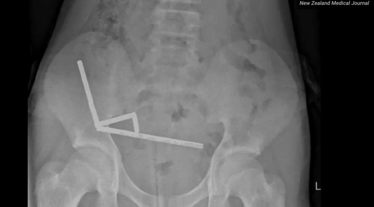 #Salud: Insólito! Cirujanos extraen nada menos que 100 imanes del intestino de un chico de 13 años