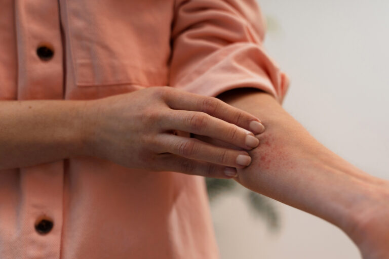 #Salud: ¿Por qué aparecen los brotes de psoriasis?