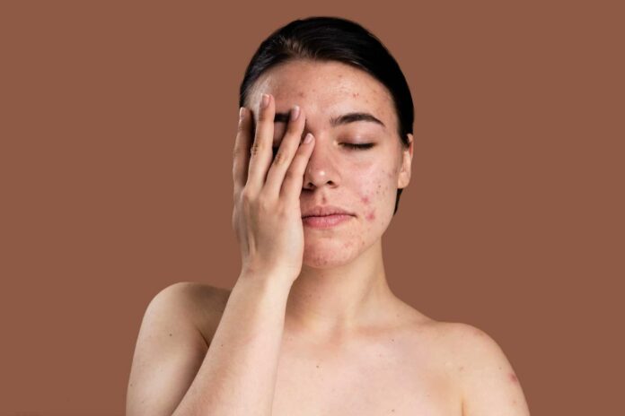 ¿Acne-durante-la-ovulacion-Por-que-ocurre-y-como-solucionarlo.jpg