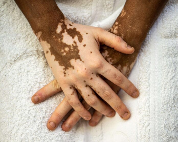 Vitiligo-primeras-manchas-en-la-piel-y-como-detectarlas.jpg